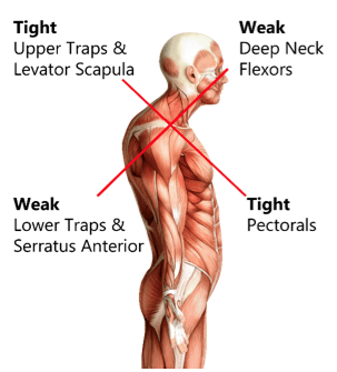 illustration explaining upper crossed syndrome