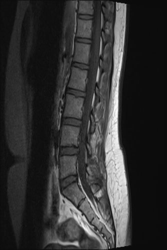 MRI scan of low back pain