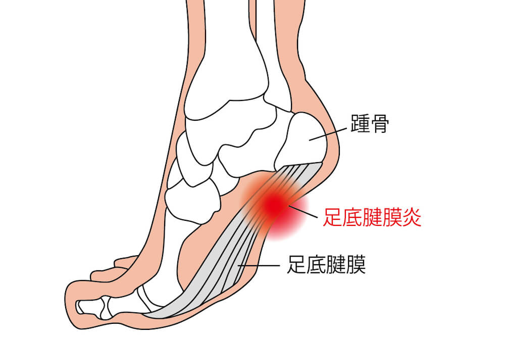 足底筋膜炎 理学療法士による治療とリハビリ 神戸三宮ライフロング