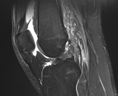 横から前十字靭帯を撮影したMRI検査の画像