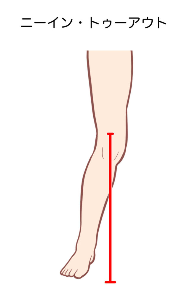 illustration of knee-in and toe-out motion of a knee joint