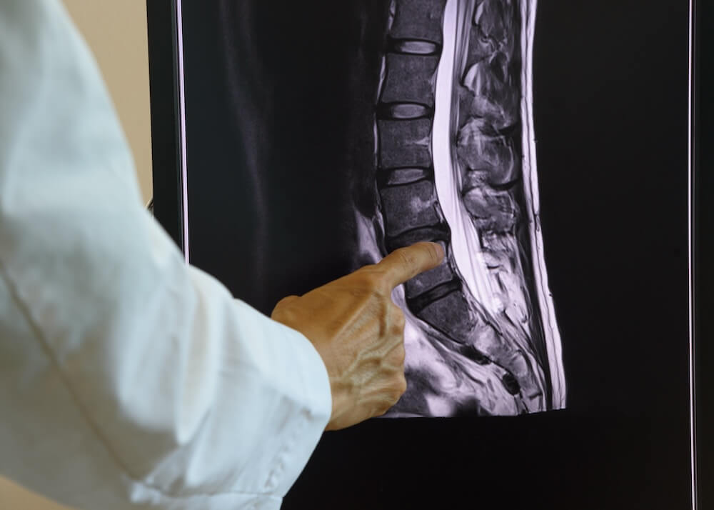 a doctor is seeing picture of MRI scan to diagnose lumbar disc herniation.